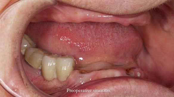 Newsletter 82 Mary - A complete upper and a one-tooth gasket denture