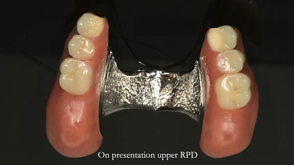 Newsletter 76: Jackie’s case – Telescopic overdenture & precision RPD (the tricky truth!)