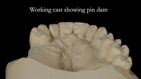 Finlay's Newsletter 64 case study - provision of a Kennedy class 2 metal based Scandinavian RPD for Ian