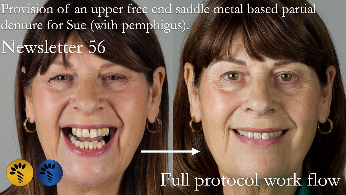 Newsletter 56 showing the making and fitting of a bilateral free end saddle upper removable partial denture (RPD) for patient with pemphigus