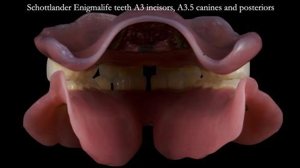 Newsletter 53 showing the making and fitting of ultra life-like dentures for Valena