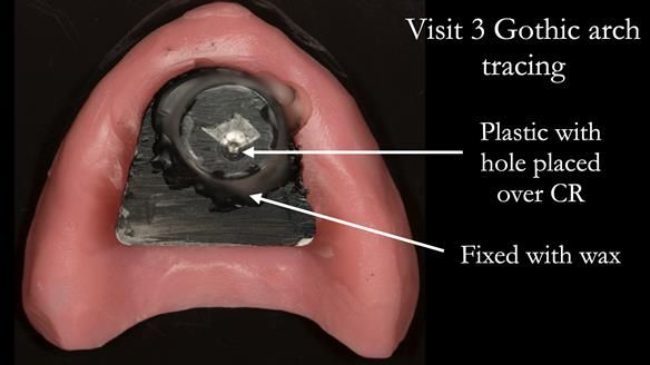 Newsletter 75: Marion’s case - Step-by-step complete denture workflow
