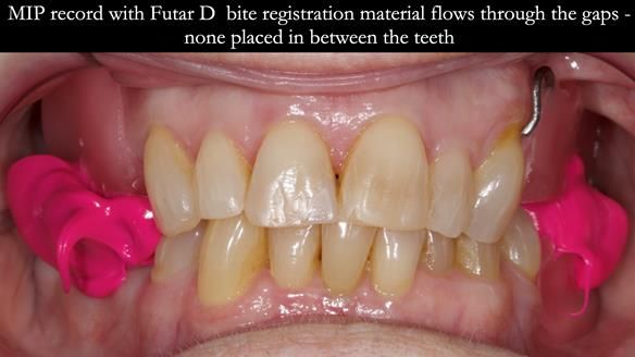 Finlay's Newsletter 60 Sylvia's upper Kennedy Class 2 Mod 1 metal based upper RPD