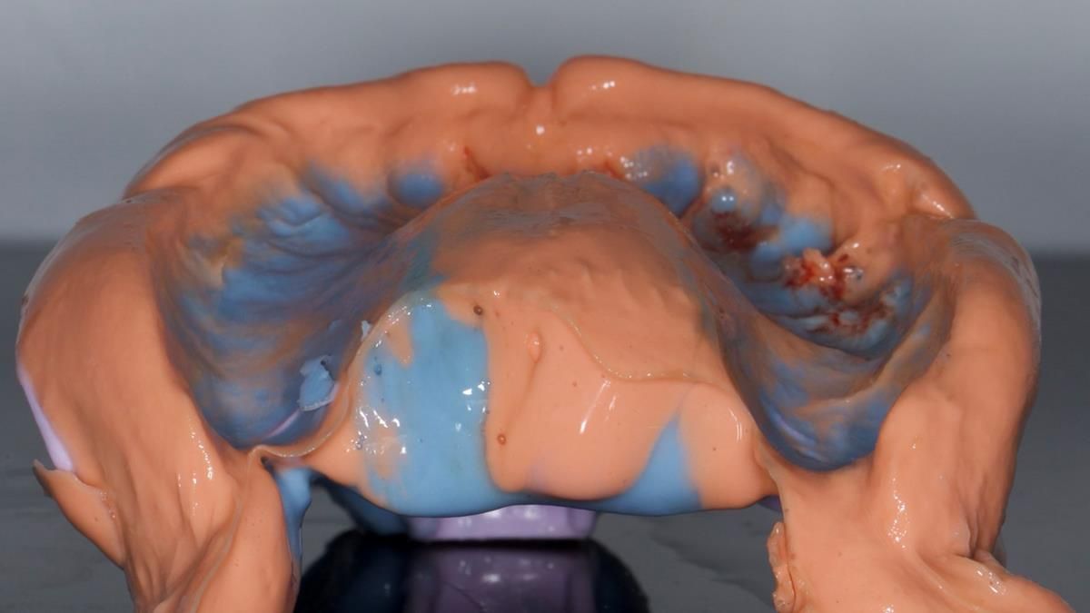 Fin’s Newsletter 88 — Complete dentures - full protocol… he rearranged his own teeth!