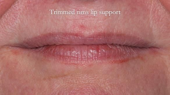 Finlay's Newsletter 58 Gasket upper partial denture for Zoe