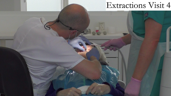 Figure 31 Extraction of the upper teeth