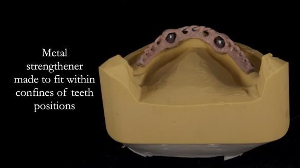 Newsletter 57 showcases the making and fitting process of implant-supported complete dentures for Alisdair