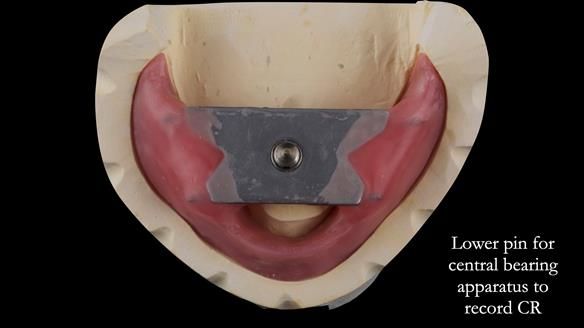 Replacing Madeline’s Complete denture FULL PROTOCOL