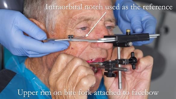 Newsletter 54 case presentation upper complete denture and lower Scandinavian designed hygienic partial denture for David