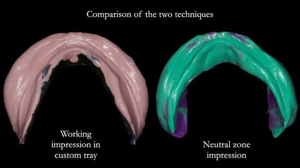 Newsletter 83: Sheila’s Complete Denture Success