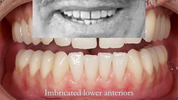 Newsletter 78: What do Clark Gable and a Locator® overdenture have in common?