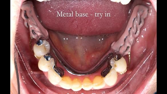 Solving Linda’s Failed “All on 4” implant bridges - full protocol Newsletter 42
