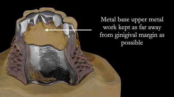 Finlay's Case Study Newsletter 40 - Immediate Mk 1 RPD to Definitive Mk 2 RPD - full protocol