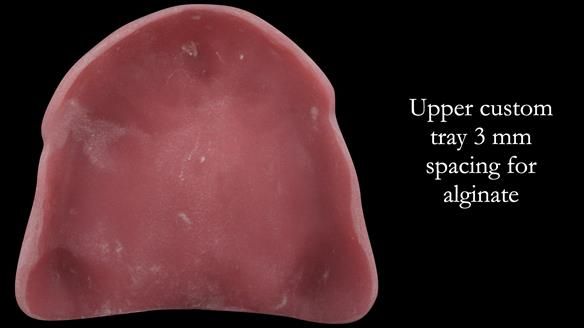 Complete denture Class II div 2 deep overbite Newsletter 39