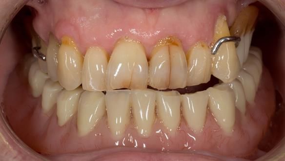 Figure 3 Pre - treatment. High smile line showing metal clasp. Upper partial denture and lower implant supported complete denture.