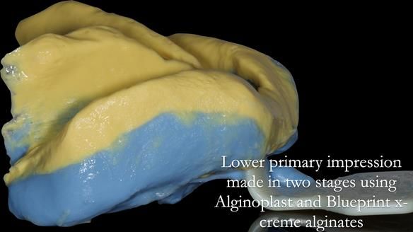 Newsletter 53 showing the making and fitting of ultra life-like dentures for Valena