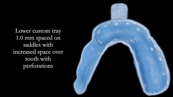 Finlay's Newsletter 61 provision of a lower unilateral free end saddle metal based partial denture for Joyce