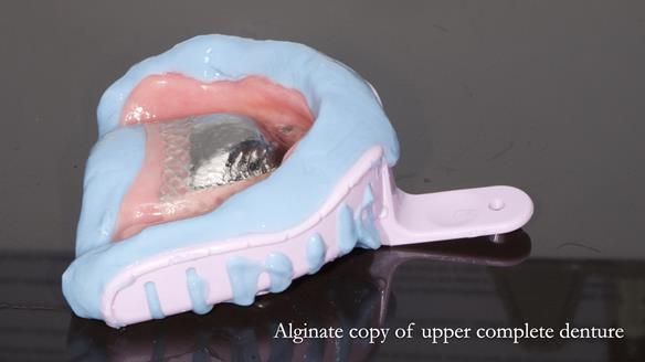 Newsletter 82 Mary - A complete upper and a one-tooth gasket denture