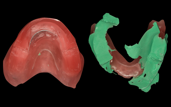 Figure 81 Primary registration rims used to record the APPROXIMATE centric relation (CR) and occlusal vertical dimension (OVD) to enable mounting of the definitive casts to fabricate the central bearing apparatus plates parallel to each other. Important s