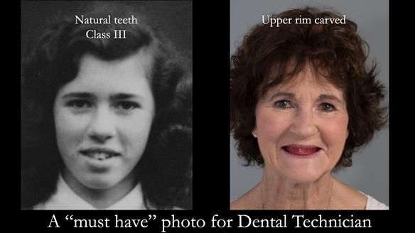 Newsletter 75: Marion’s case - Step-by-step complete denture workflow