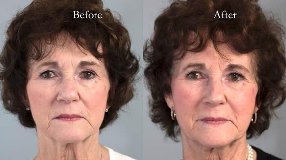 Newsletter 75: Marion’s case - Step-by-step complete denture workflow