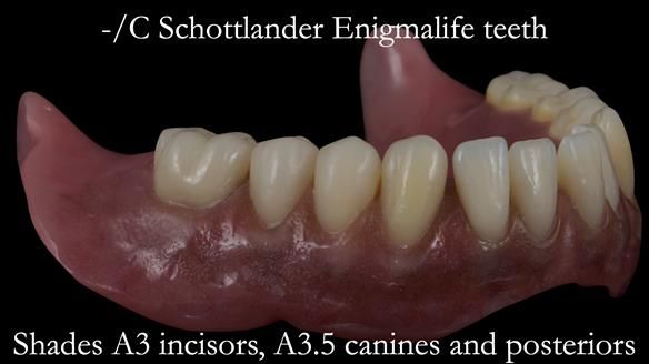 Newsletter 53 showing the making and fitting of ultra life-like dentures for Valena