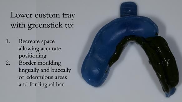 Newsletter 55 Provision of metal based partial dentures for Zephyrine with a repaired cleft lip and palate