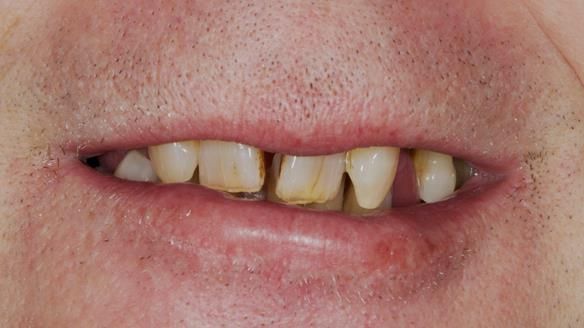 Newsletter 86 Peter the Architect — precision removable partial dentures case study