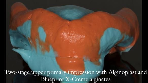 Newsletter 75: Marion’s case - Step-by-step complete denture workflow