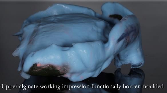 Finlay's Newsletter 58 Gasket upper partial denture for Zoe