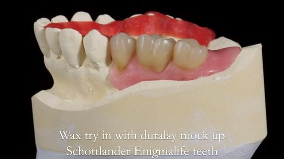 Finlay's Newsletter 64 case study - provision of a Kennedy class 2 metal based Scandinavian RPD for Ian