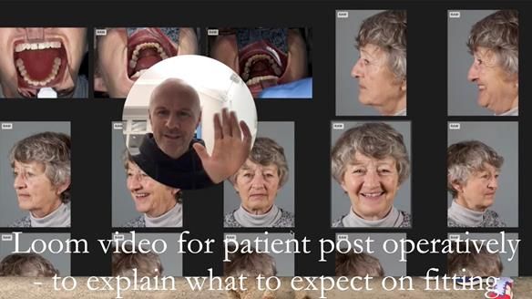 Solving Linda’s Failed “All on 4” implant bridges - full protocol Newsletter 42