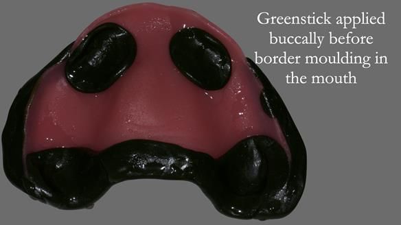 Newsletter 52 Managing Jo’s failing dentition with extractions and Mk 1/Mk 2 complete upper dentures and lower partial dentures FULL PROTOCOL