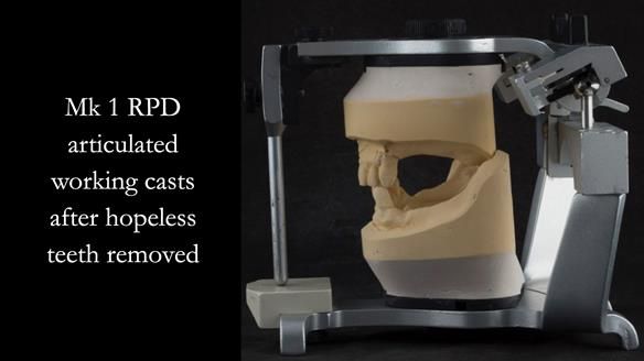 Finlay's Case Study Newsletter 40 - Immediate Mk 1 RPD to Definitive Mk 2 RPD - full protocol