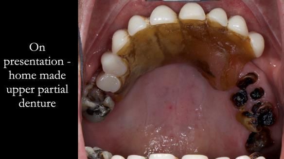 Newsletter 52 Managing Jo’s failing dentition with extractions and Mk 1/Mk 2 complete upper dentures and lower partial dentures FULL PROTOCOL