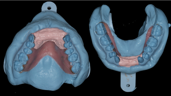  Figure 48 Immediate denture laboratory relines - part 2 alginate over impression in stock tray. Blueprint Dentsply.