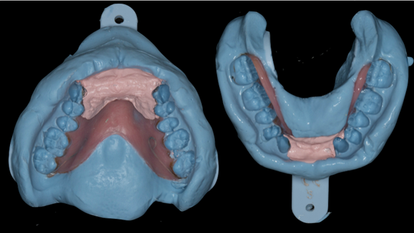 Figure 48 Immediate denture laboratory relines - part 2 alginate over impression in stock tray. Blueprint Dentsply.