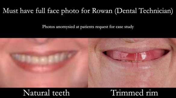 Newsletter 52 Managing Jo’s failing dentition with extractions and Mk 1/Mk 2 complete upper dentures and lower partial dentures FULL PROTOCOL