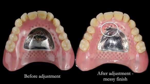 Newsletter 82 Mary - A complete upper and a one-tooth gasket denture