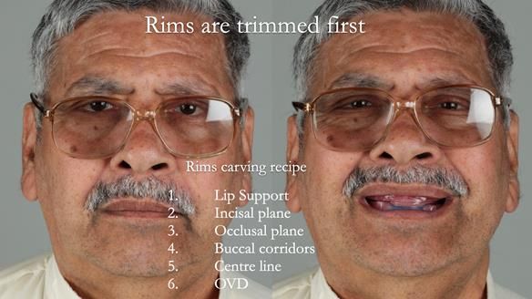 Finlay's Newsletter 62 provision of extractions and metal based complete dentures for Rafique