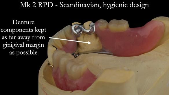 Finlay's Case Study Newsletter 40 - Immediate Mk 1 RPD to Definitive Mk 2 RPD - full protocol