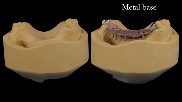 Upper metal base partial denture/occlusal stabilisation splint/obturator - full protocol