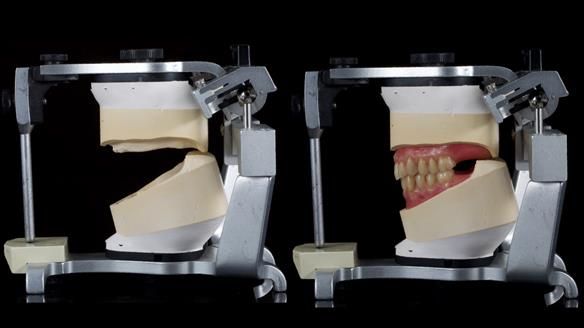 Newsletter 80 - Gordon’s dentures: the one case in 1,000 where my technique failed