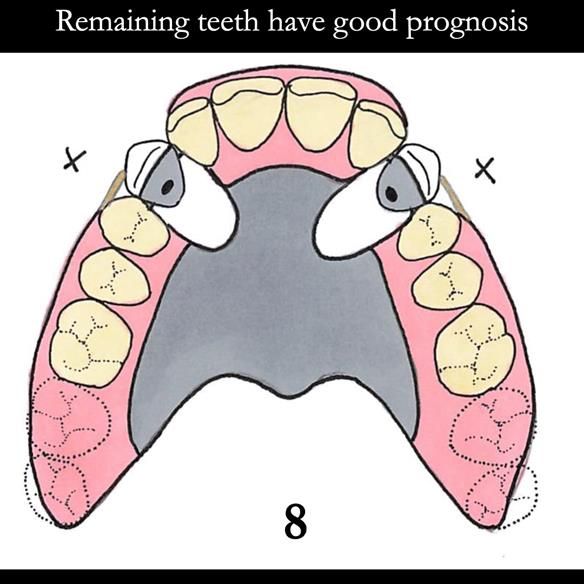 Universal Scandinavian partial denture designs