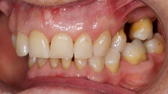 Finlay's Newsletter 61 provision of a lower unilateral free end saddle metal based partial denture for Joyce