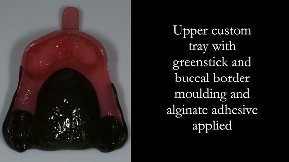 Finlay's Case Study Newsletter 40 - Immediate Mk 1 RPD to Definitive Mk 2 RPD - full protocol