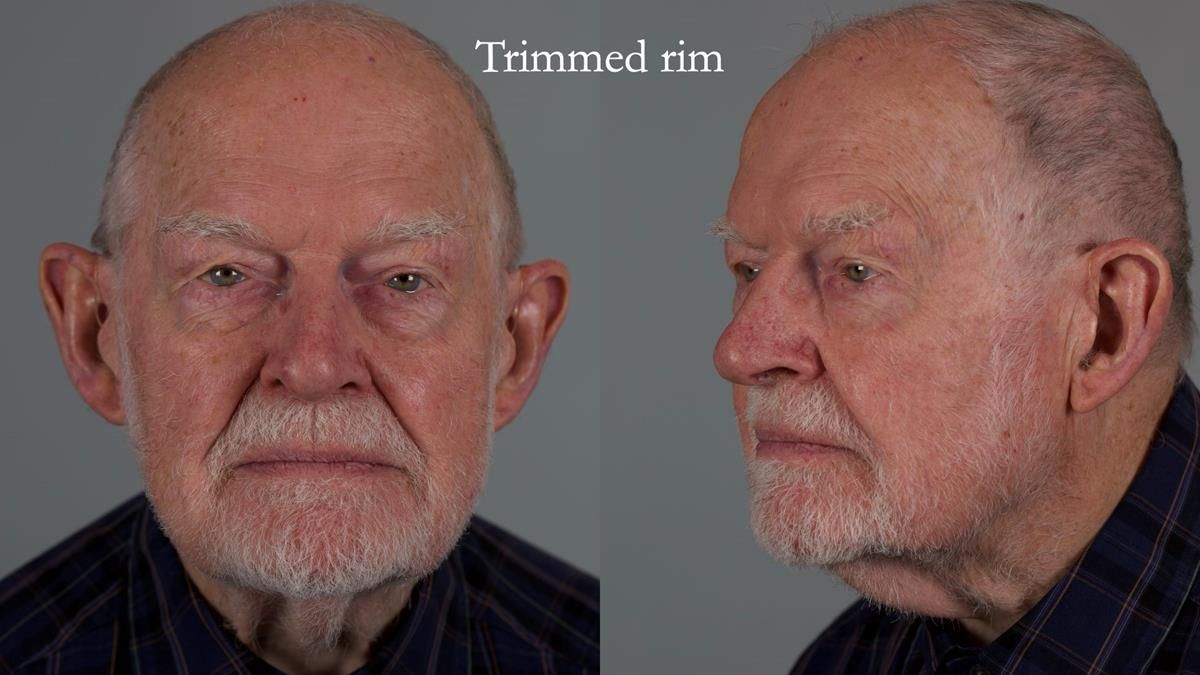 Newsletter 87 – Father Peter: A Partial Denture that needed Minor Miracle