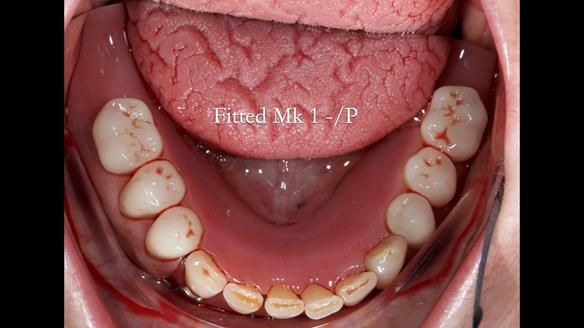 Newsletter 52 Managing Jo’s failing dentition with extractions and Mk 1/Mk 2 complete upper dentures and lower partial dentures FULL PROTOCOL