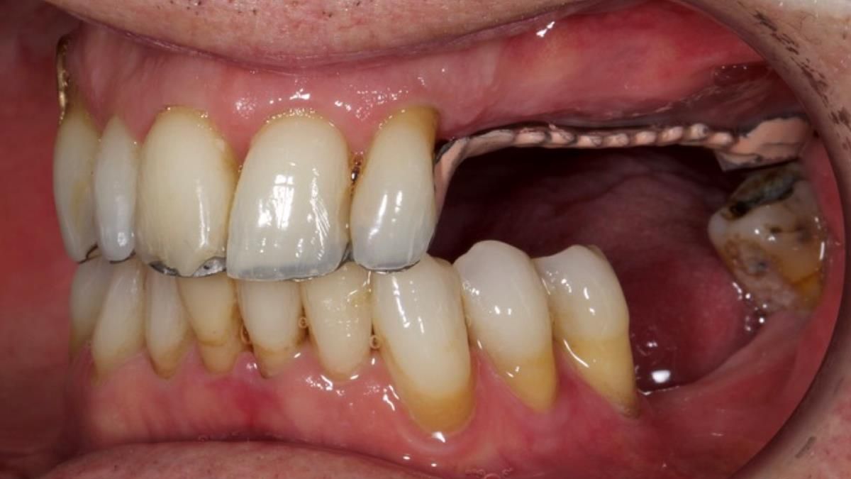 Newsletter 89 – Simon: A Challenging Kennedy Class II Division 1 Upper CoCr Partial Denture with a High Smile Line