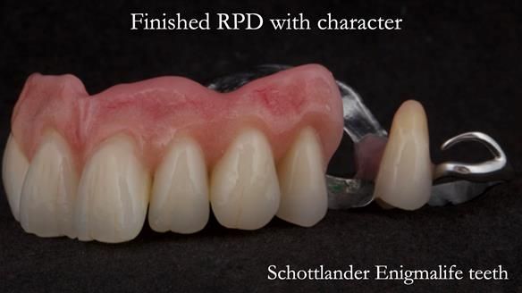 Eileen's transformation with upper and lower RPDs of Scandinavian hygienic design FULL PROTOCOL